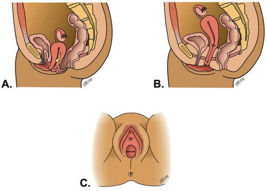Vaginal Hysterectomy for Uterine Prolapse and Vaginal Repair