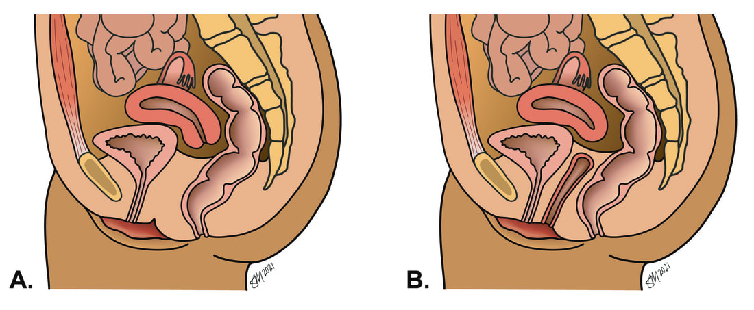 images showing vaginal agenesis