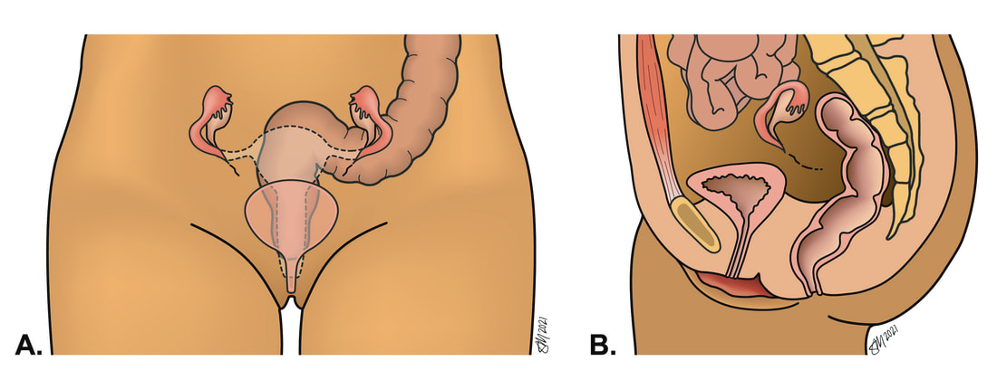 images showing uterine agenesis