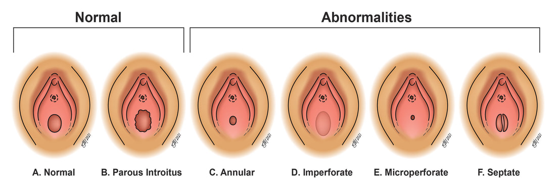 normal vs abnormal hymens