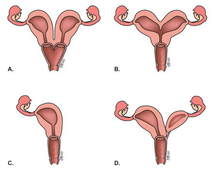 images showing anomalies of the uterus