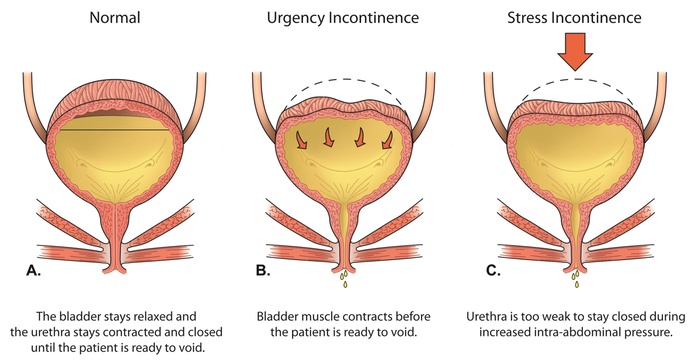 functional incontinence